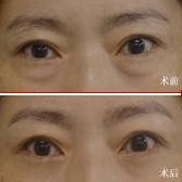 韩式泪感去眼袋