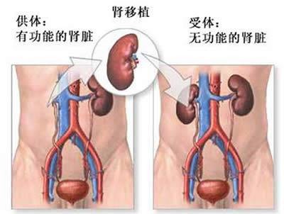 肾移植术后