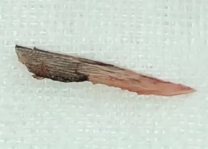 广东一女子被鱼鳍刺伤后举着鱼去医院就诊,你如何看待女子的做法?