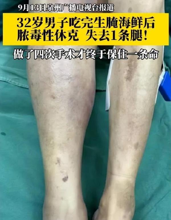 男子吃生腌海鲜后做4次手术失去1条腿 更多细节曝光