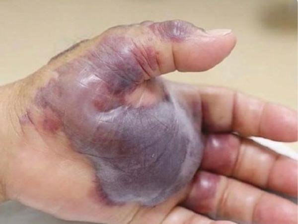 男子吃生腌海鲜后做4次手术失去1条腿 更多细节曝光