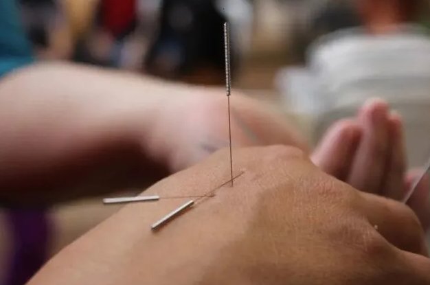 学针灸一般要学多久？